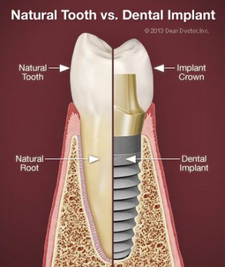 https://www.broadwaydentalstudio.co.uk/wp-content/uploads/2015/11/natural-tooth-vs-dental-implant-320x379.jpg
